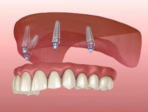 All-on-4 or Full mouth implant