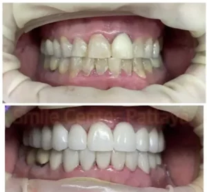 Teeth Whitening Pattaya