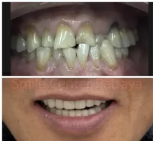 before_after6