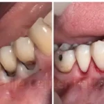 Tooth Filling 