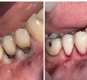 Dental works in Pattaya