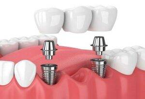 Bridge on implants