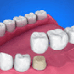 Dental Bridge
