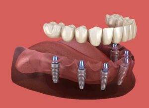 Full mouth arch Implants