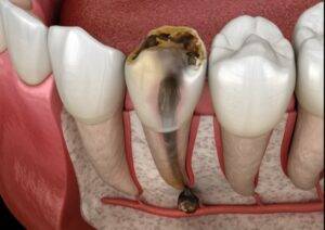 Root Canal treatment