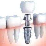 Dental Implant