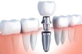 Single implant
