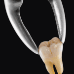 Tooth Extraction