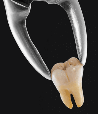 Tooth extraction
