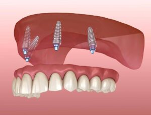 Illustration of four dental implants supporting a full arch of teeth