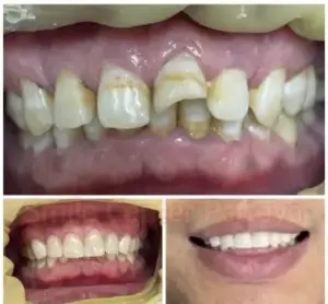 Before-and-after photographs showing damaged front teeth and a restored smile