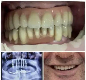 Teeth before treatment, a dental X-ray and a smile after treatment