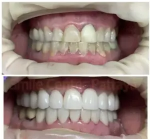 Before-and-after photographs of upper and lower teeth