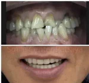 Before-and-after photographs comparing teeth and smile appearance