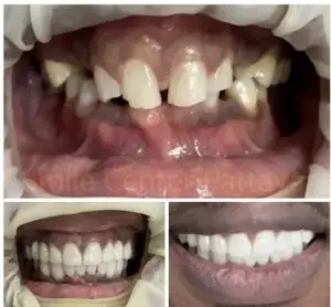 Before-and-after photographs showing front teeth and a restored smile