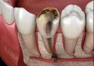 Cutaway illustration of a decayed tooth and its root canals
