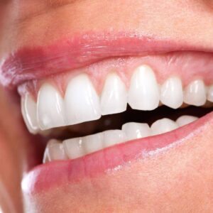 Close-up of a smile showing upper and lower teeth